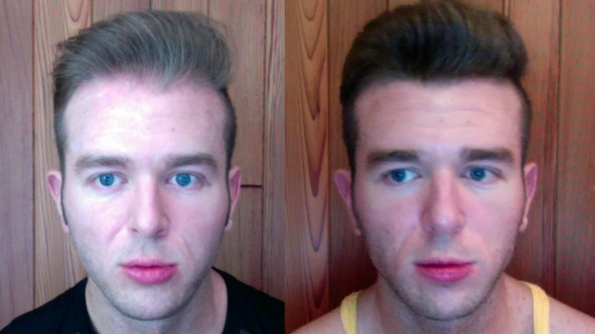 finasteride before and after 1 year